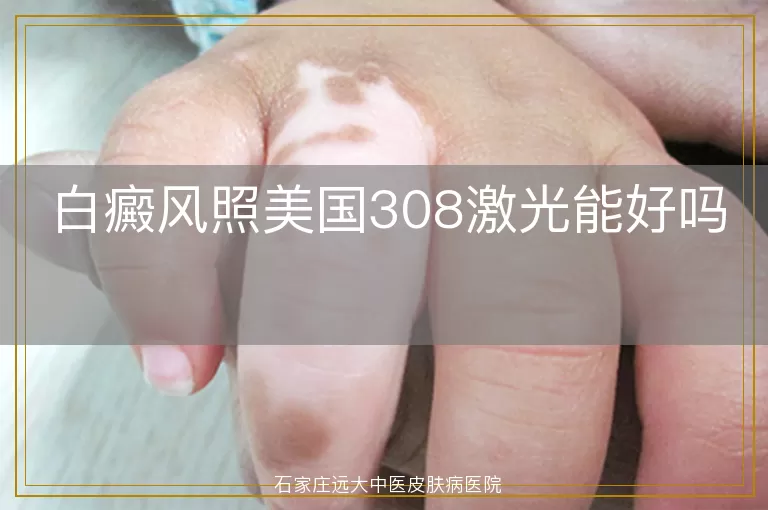 白癜风照美国308激光能好吗