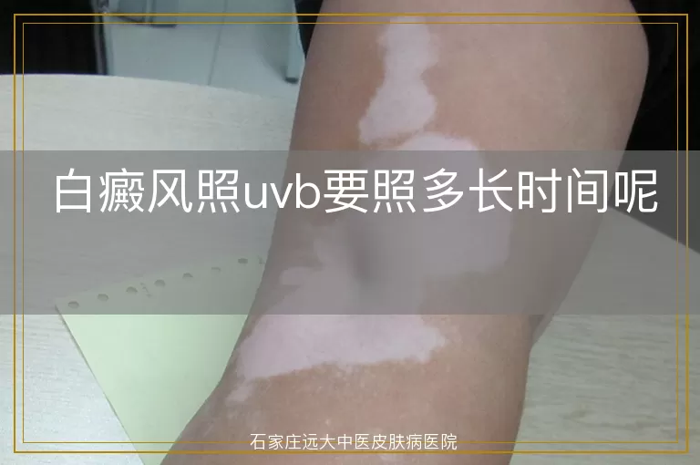 白癜风照uvb要照多长时间呢