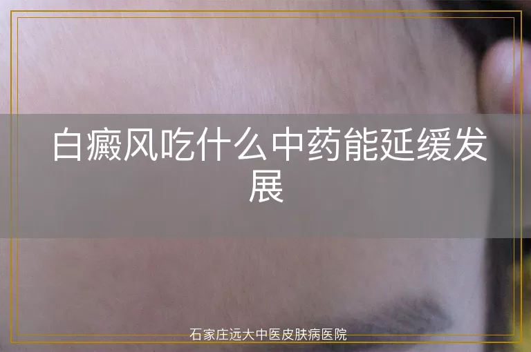 白癜风吃什么中药能延缓发展