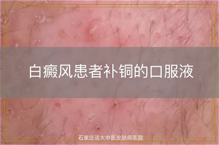 白癜风患者补铜的口服液