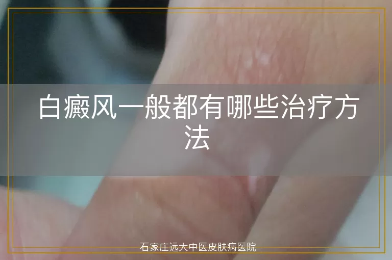 白癜风一般都有哪些治疗方法