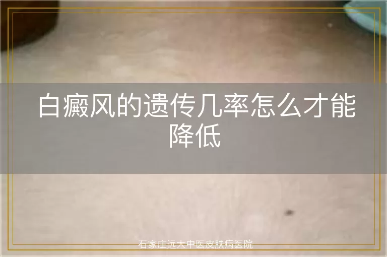 白癜风的遗传几率怎么才能降低