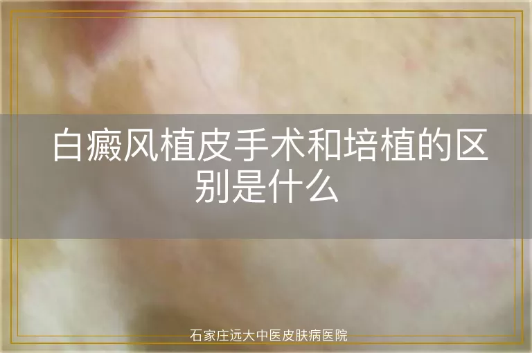 白癜风植皮手术和培植的区别是什么