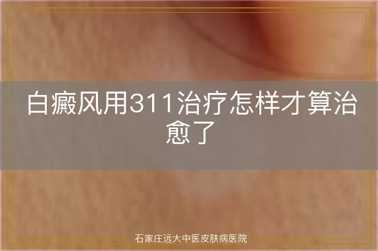 白癜风用311治疗怎样才算治愈了