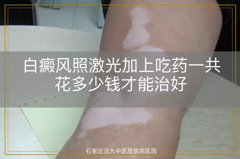 白癜风照激光加上吃药一共花多少钱才能治好