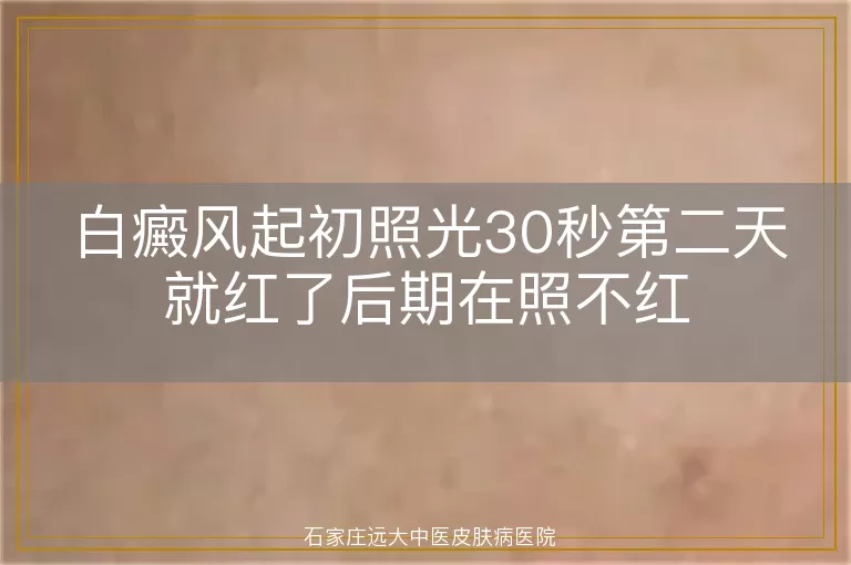 白癜风起初照光30秒第二天就红了后期在照不红