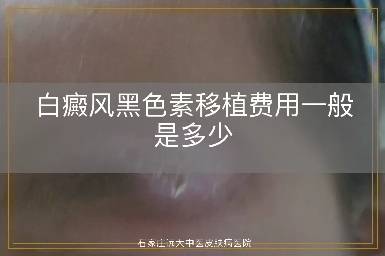 白癜风黑色素移植费用一般是多少