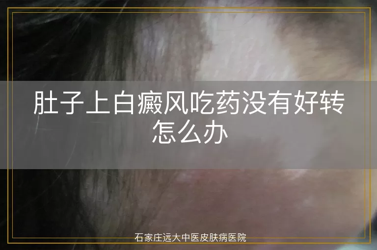 肚子上白癜风吃药没有好转怎么办