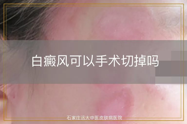 白癜风可以手术切掉吗
