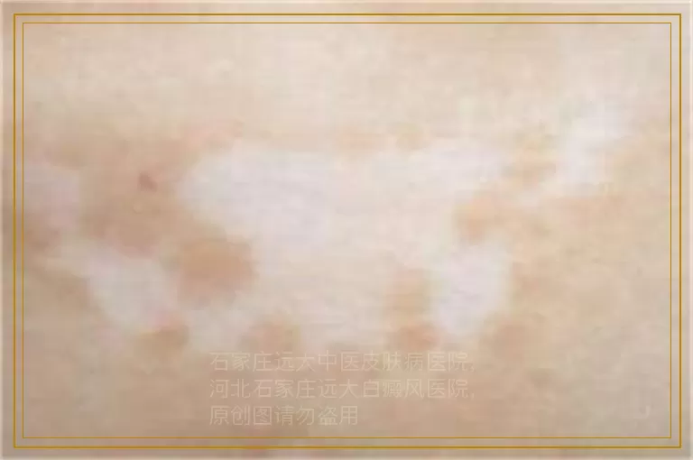 白癜风擦什么药恢复的比较快
