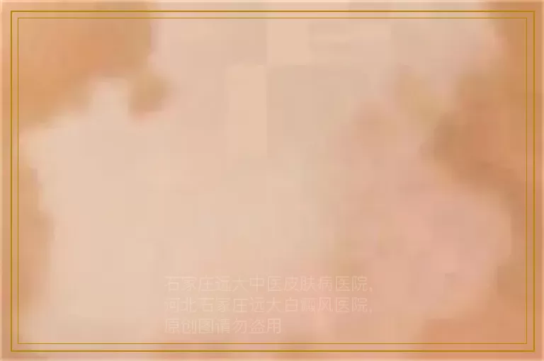 白癜风照308一个光斑40块钱合理不