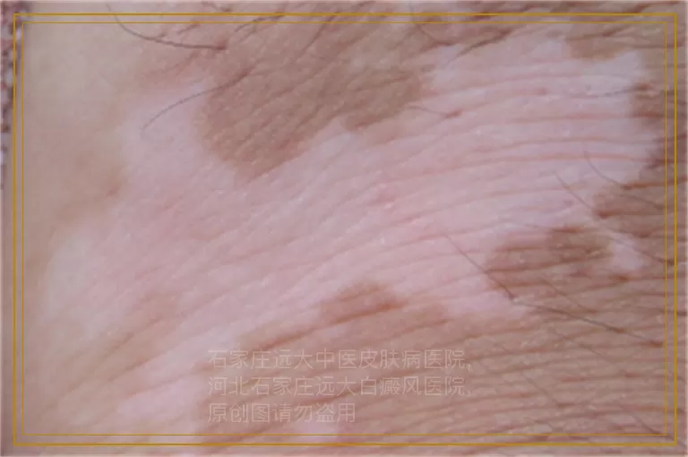 白癜风皮肤变白毛发没变白还能治疗吗