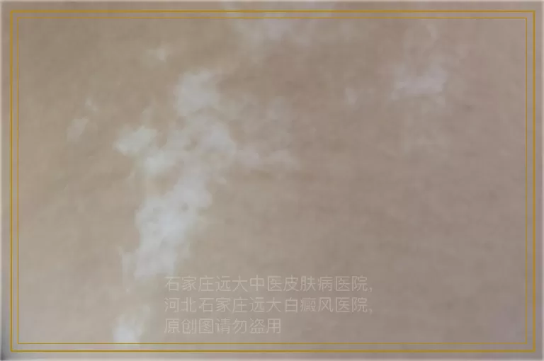 白癜风激光治疗有什么要注意的