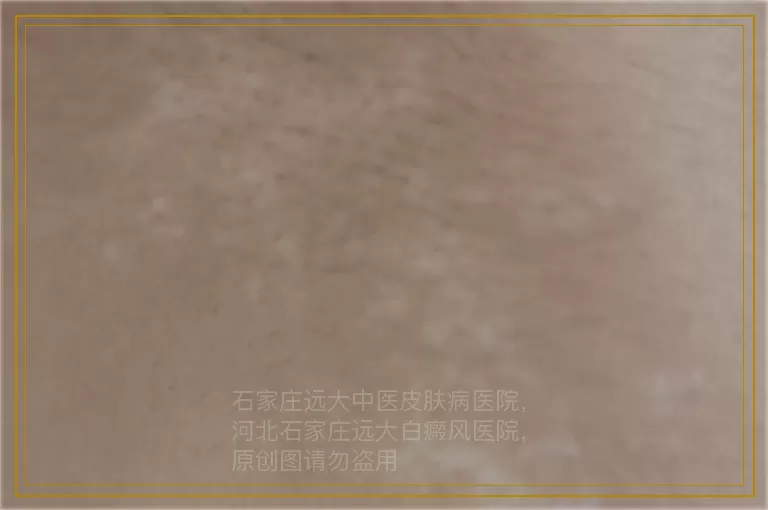 白癜风照308准分子光后起水泡瘙痒该咋办