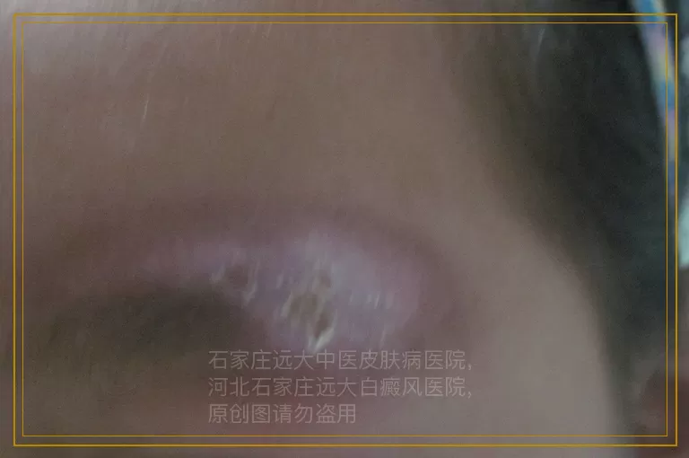 白癜风照激光不红可以用光敏药吗