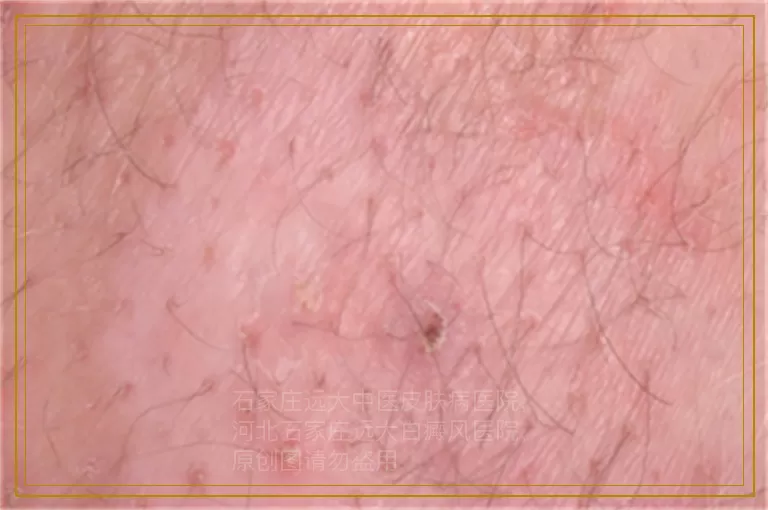 白癜风照了308后起泡怎么办