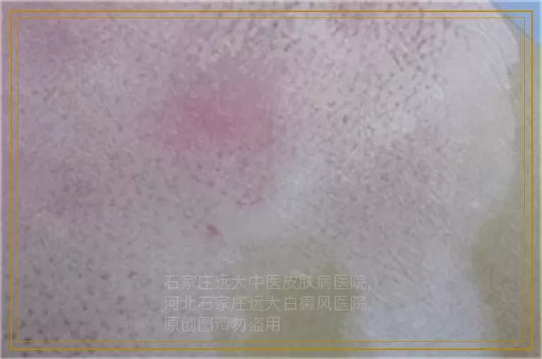 白癜风照UVB光疗后发红起泡怎么办