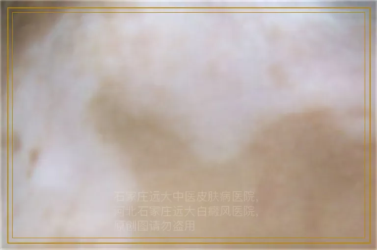 白癜风照光之后发红吗