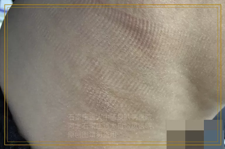 白癜风能不能扎火针治疗白癜风