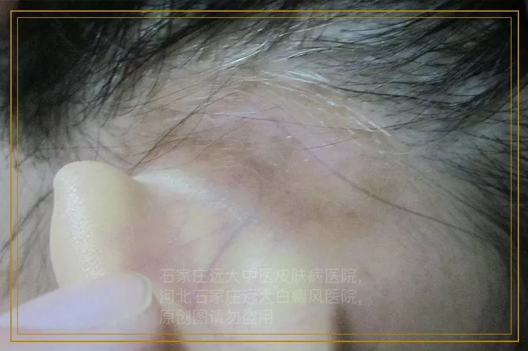 白癜风眉毛变白了多久恢复正常