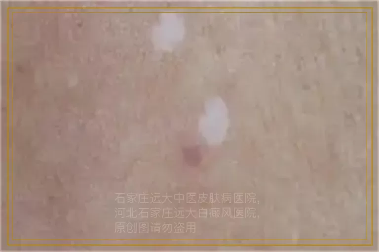 白癜风发展期是吃药控制后再照光吗