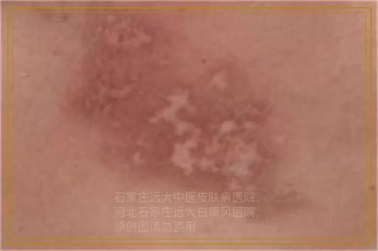 白癜风白斑状态要怎么治能好