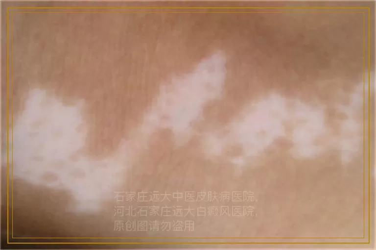 白癜风照了308皮肤发红脱皮是什么原因