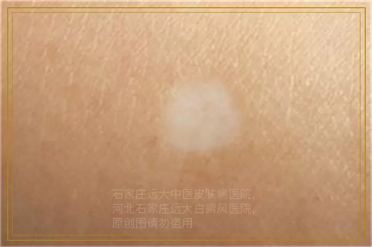 白癜风照308怎么照也不红咋回事