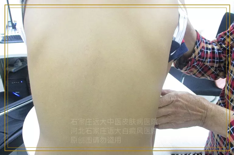 白癜风抹了药膏还能照光吗