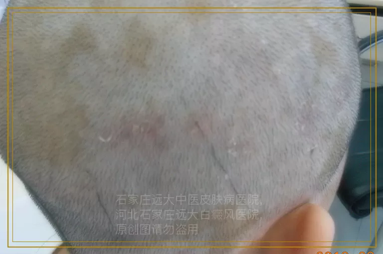 uvb光照白斑配合卤米松效果怎么样