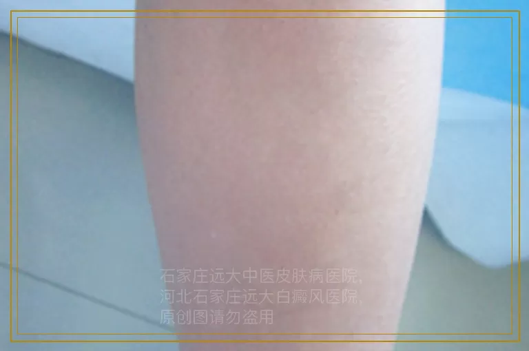 白癜风照308十几次了还没好