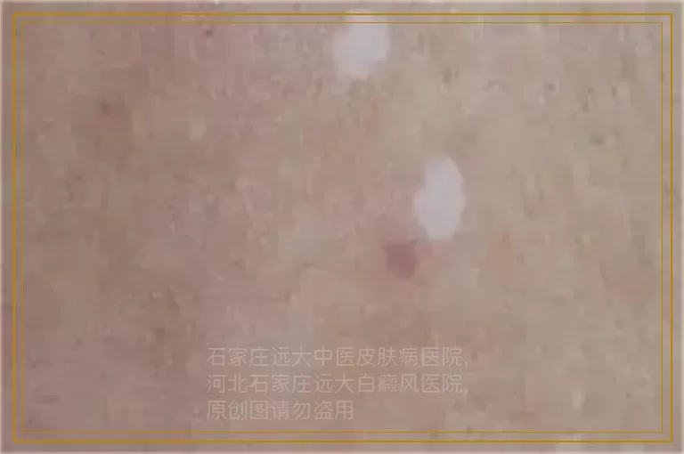 白癜风初期打补骨脂针能治好吗