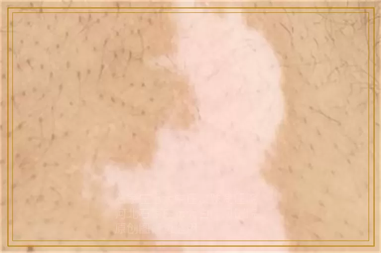 白癜风患者人人都可以手术医治吗