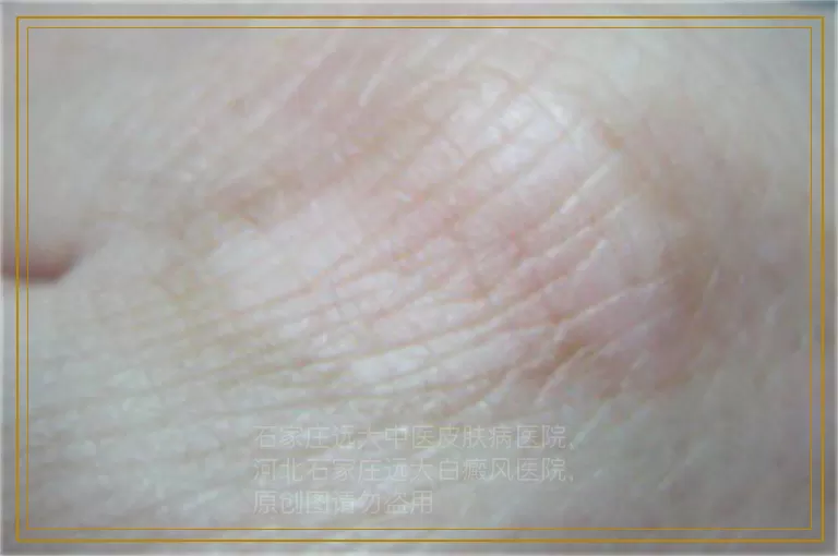 白癜风在扩散期间用什么方法治疗