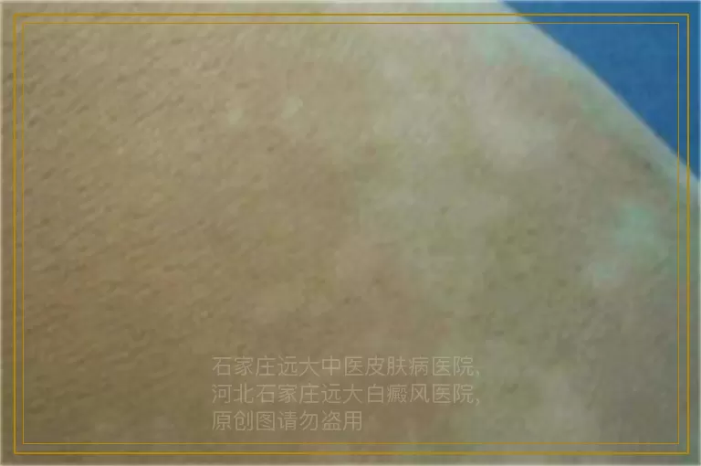 白癜风里冒黑点后再没扩散