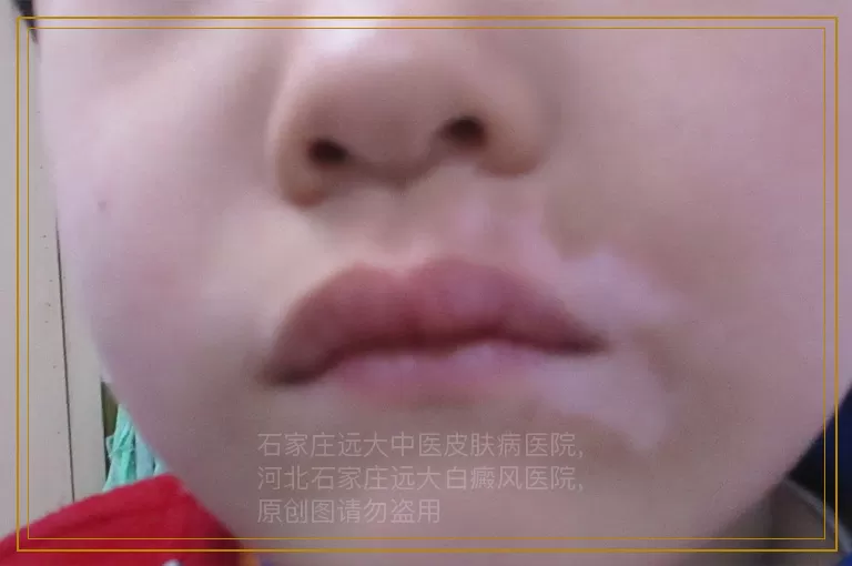 白癜风照308起水泡了怎么处理