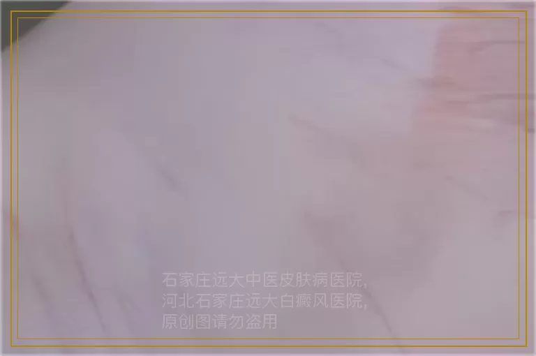 白癜风部位有指甲盖那么大治疗了一年还没好