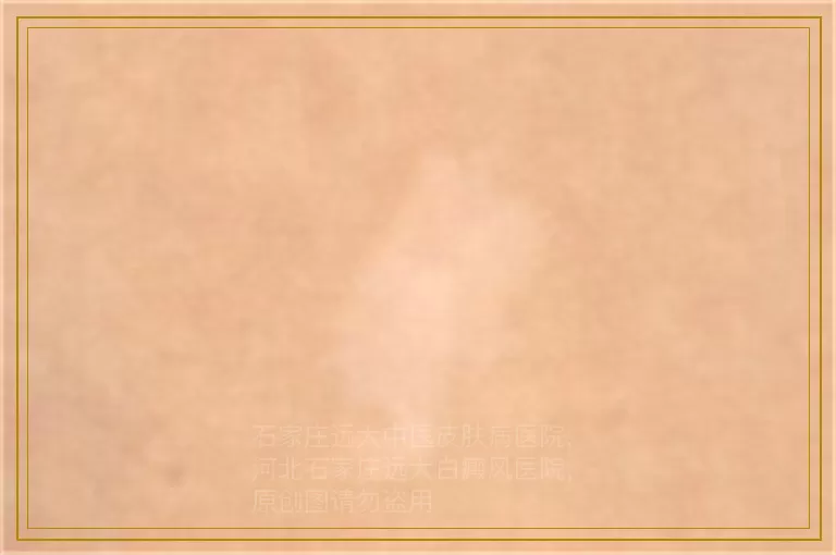 白癜风白斑早期用补骨脂管用吗