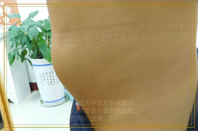 白癜风移植平方一厘米多少钱