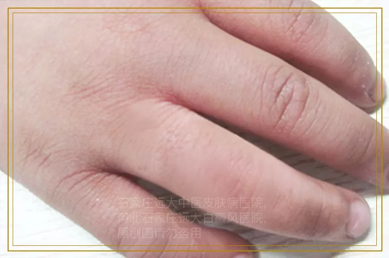 白癜风可以拔火罐吗