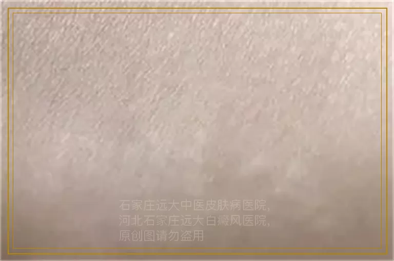 白癜风割耳放血治疗法好吗