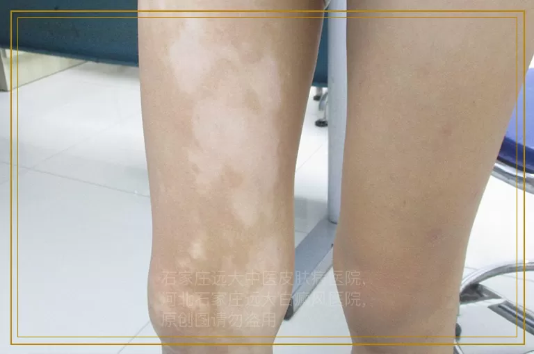 白癜风抹药后越来越白了怎么办