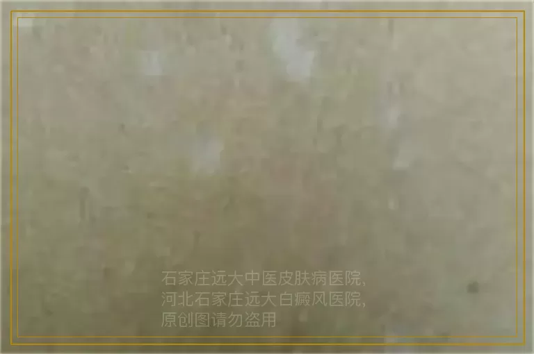 白癜风照308一年了还没好怎么办