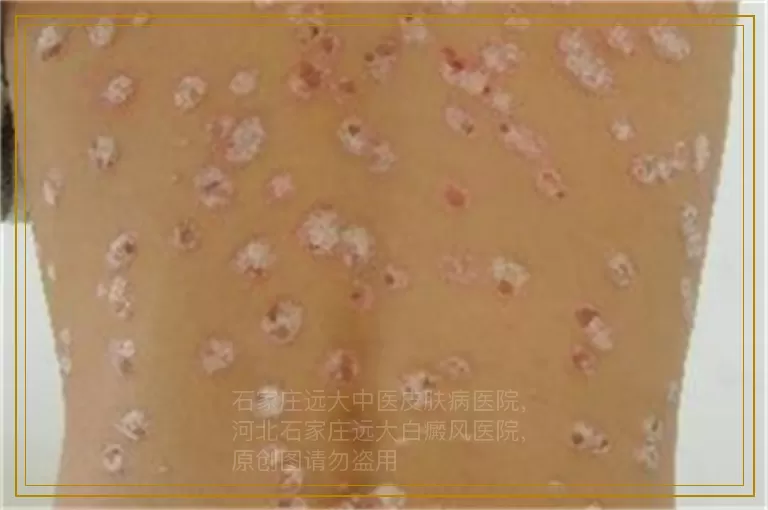 白癜风怎么治疗不伤身体