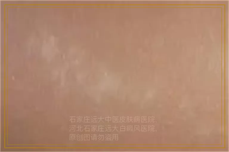 白癜风不治疗能行吗