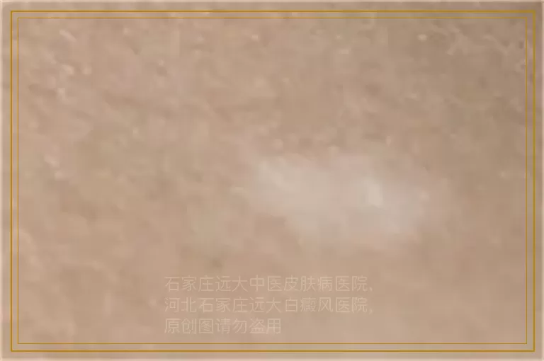 白癜风照308光照了两次不见好转