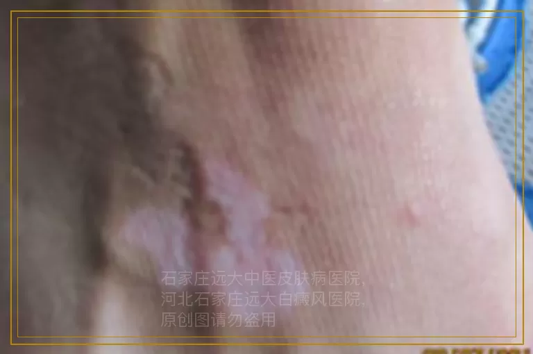 白癜风的治疗费用听说很贵