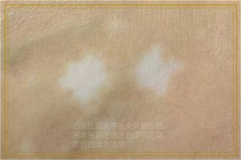 白癜风照光后变成粉红色