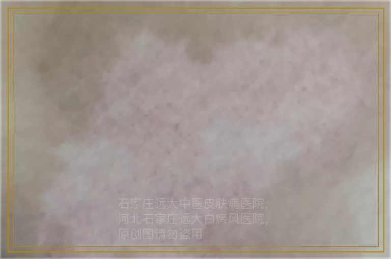 白癜风照308激光多久能好