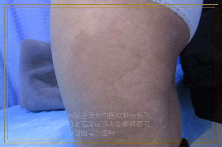 白癜风有一元硬币那么大能治好吗